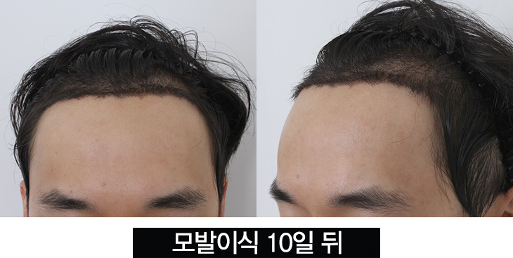 hair transplant before after korea