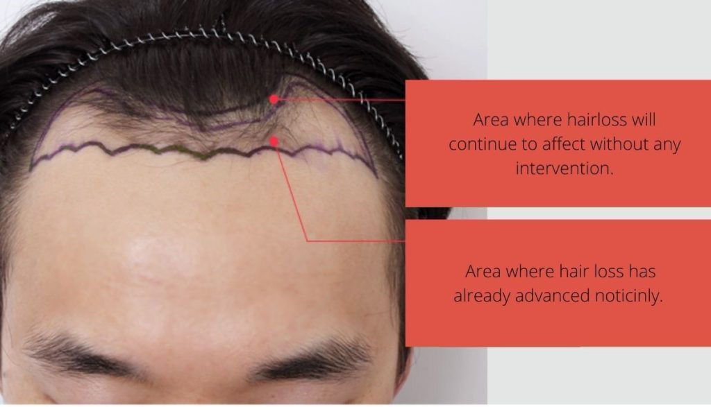before after hair transplant 10 months