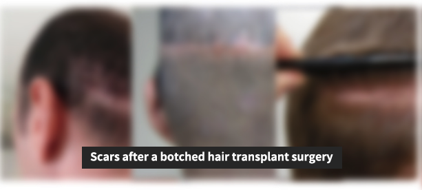 hair transplant scars revision surgery