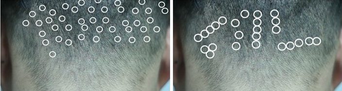 fue hair transplant scars