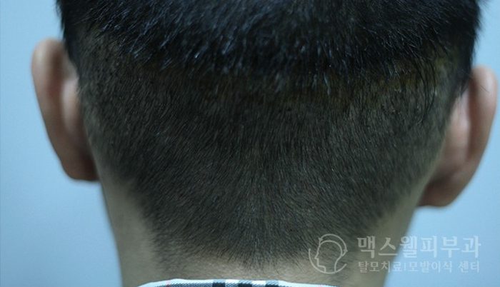 fue hair transplant scar