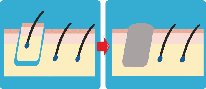 fue hair transplant scar