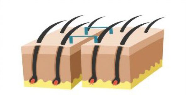 hair transplant scar stitching techinques