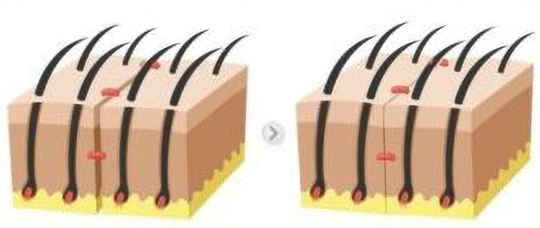 hair transplant scar stitching techinques