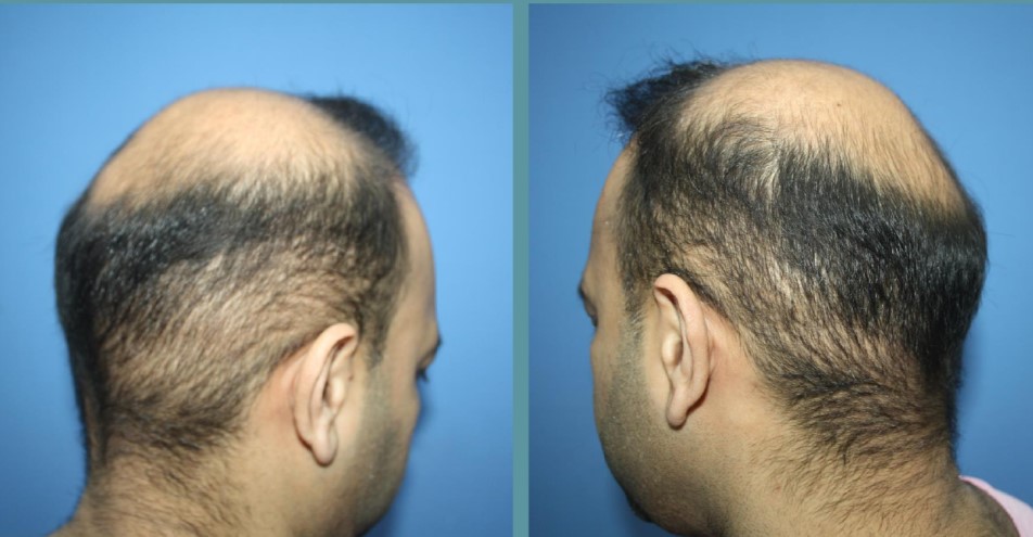 over harvesting hair transplant scar