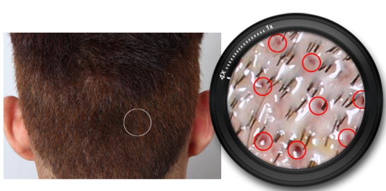 hair transplant scar revision surgery