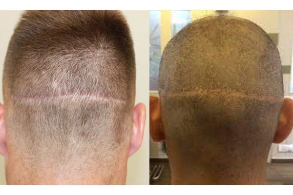 hair transplant scar