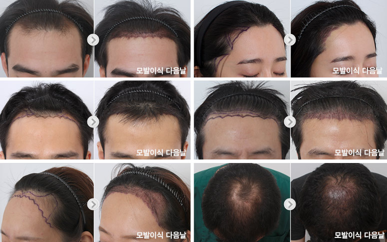 maxwell hair transplant recovery time 12 months